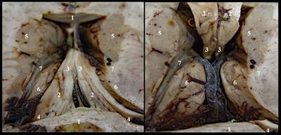 Triangular fossa of the third cerebral ventricle – an original 3D model and morphometric study